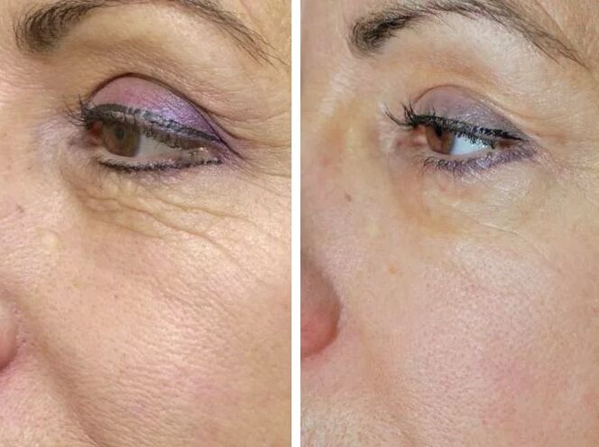 Lauka lāzers pirms un pēc